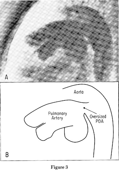 Figure 3 from Nonsurgical Closure of Oversized Patent Ductus Arteriosus with Pulmonary ...