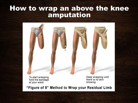 PPT - AMPUTATIONS PowerPoint Presentation, free download - ID:6749099