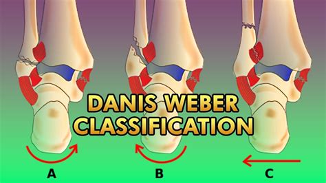 Danis Weber Classification of Malleolar Fractures of The Ankle - YouTube