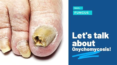 Get Rid of Unsightly Fungal Toenails | Same Day Appointment