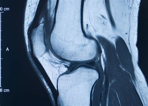 Knee injury mri mcl tear stock photo. Image of fracture - 156029502