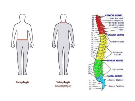 paraplegic vs quadriplegic - ค้นหาด้วย Google | Lesão medular, Sistema ...