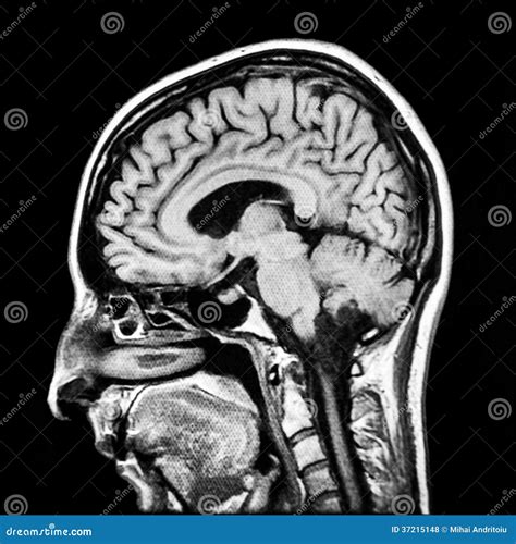 Human Brain MRI Scan Royalty Free Stock Photos - Image: 37215148