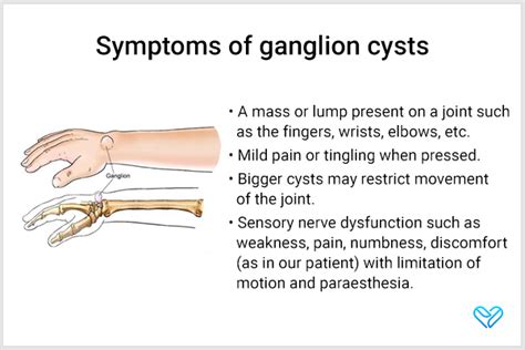 Ganglion Cyst Causes Sign And Symptoms Diagnosis And Treatment – NBKomputer