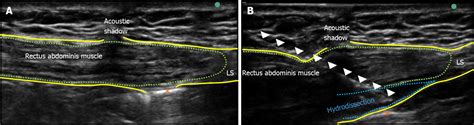 Ultrasound-guided rectus sheath block for anterior cutaneous nerve entrapment syndrome after ...