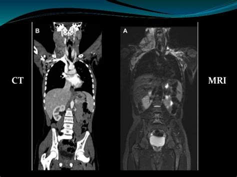 CT Scan Vs MRI Scan