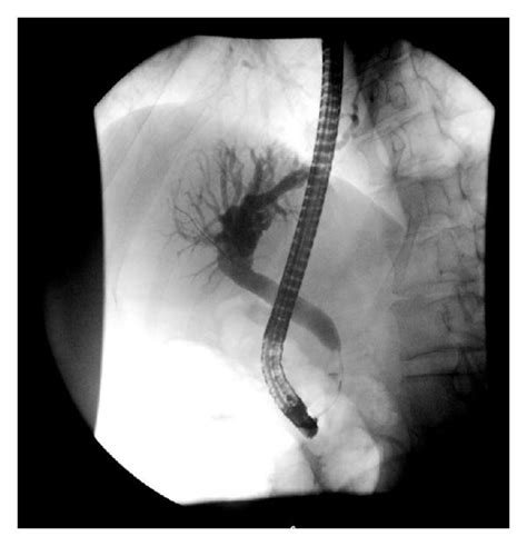 ERCP films show the proximal common bile duct stricture and dilated ...