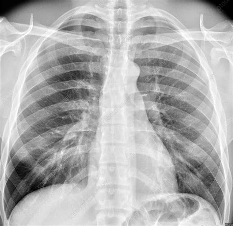 Normal chest X-ray - Stock Image - C036/6403 - Science Photo Library