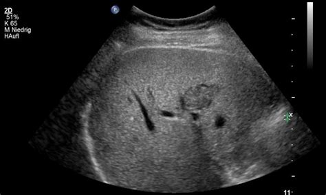 Liver Lesions Ultrasound