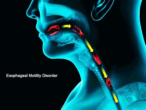 Herbal Treatment of Esophageal Motility Disorder (EMD) - Planet Ayurveda