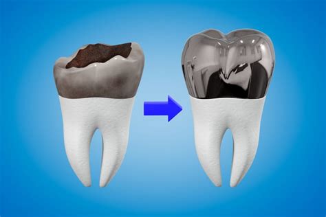 Signs that Your Dental Crown Needs to be Replaced - University Dental ...