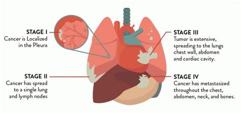 Pleural Mesothelioma: Stages, Symptoms, Causes And Treatment