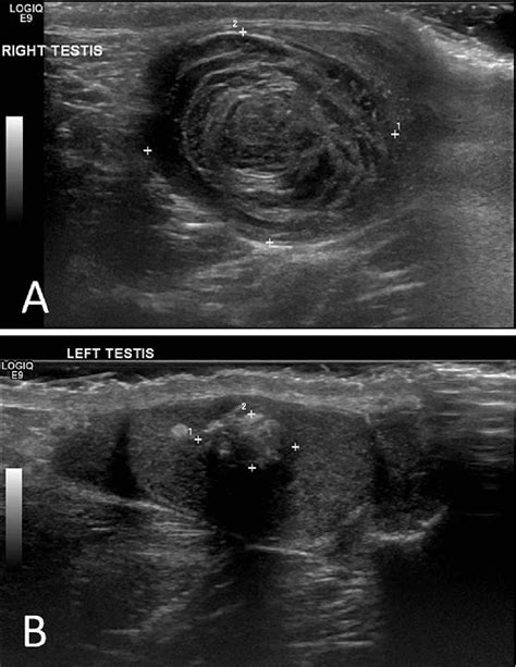 Testicular Epidermoid Cyst