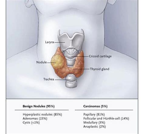 Thyroid Nodules | Endocrine and metabolic diseases | ePharmaPedia