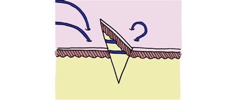 Horizontal Mattress Suture - OSCE guide | Suturing | Geeky Medics