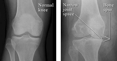 Findings on X-Rays Correlating to Knee Pain? A Blow to Pain Science ...