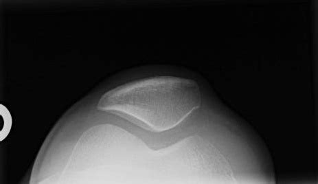 KNEE - SUNRISE RADIOGRAPH