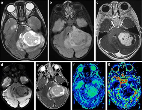 Pilocytic astrocytoma. a Axial T2-weighted scan through the cerebellum ...