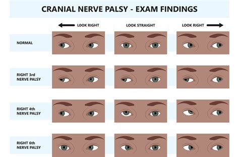 Cranial Nerve Palsy – CN III, IV, VI & VII Palsy