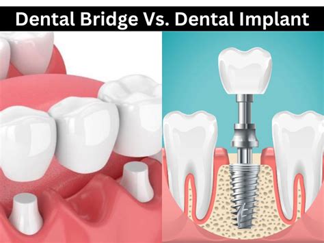 Dental Bridge Vs. Dental Implant: Advantages & Disadvantages