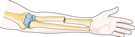 Closed fracture - Servier Medical Art