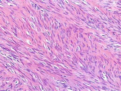 Fibrosarcoma | Radiology Key