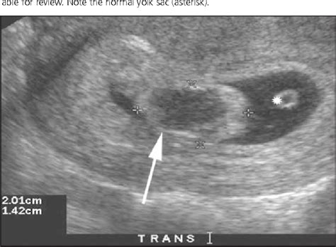 Figure 5 from The chorionic bump: a first-trimester pregnancy sonographic finding associated ...