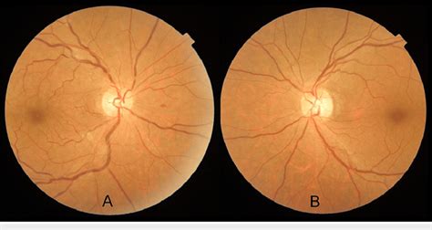 Fundus photograph A: Fundus photograph of the right eye showing mild... | Download Scientific ...