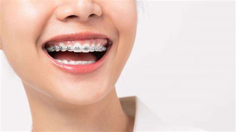 Invisalign vs Braces | Waterways Dental