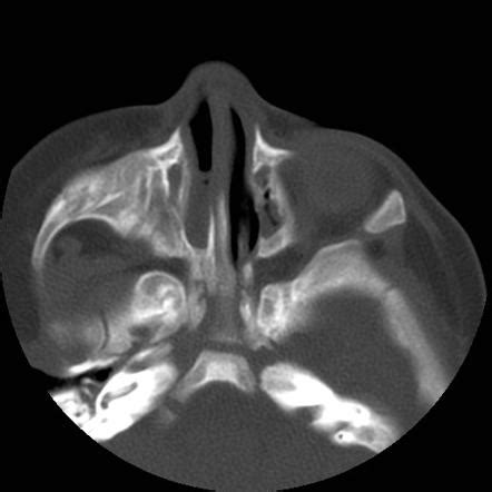 Unilateral choanal atresia | Radiology Case | Radiopaedia.org