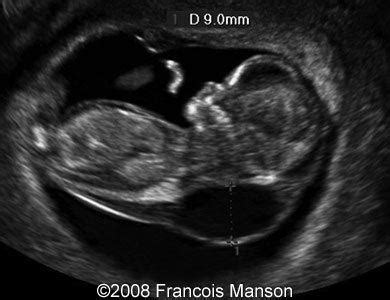 📃 Cystic hygroma, monosomy X