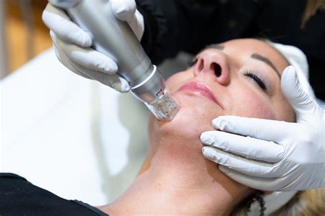 RF Microneedling Milwaukee | Best Microneedling Near Me