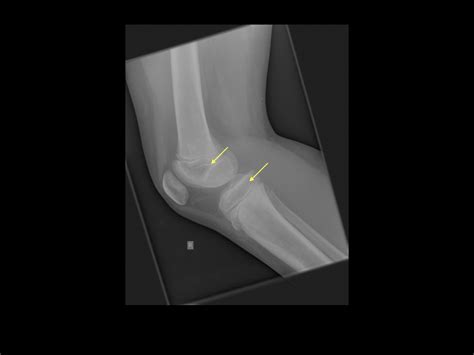 Acute lymphoblastic leukemia x ray - wikidoc