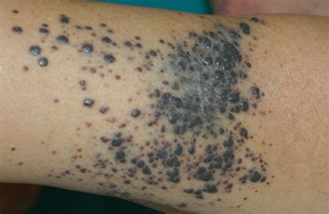 Cutaneous Metastases from Malignant Melanoma: Clinical Features and New Therapeutic Perspectives ...