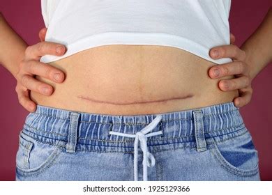 918 Hysterectomy Images, Stock Photos & Vectors | Shutterstock