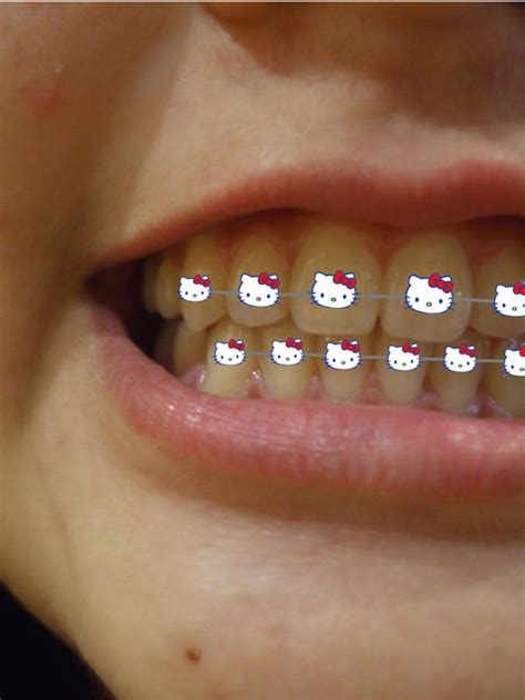 hello kitty braces by cookie4492 on DeviantArt