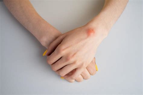 Ganglion Cysts- Causes and Treatments : Elite Sports Medicine ...