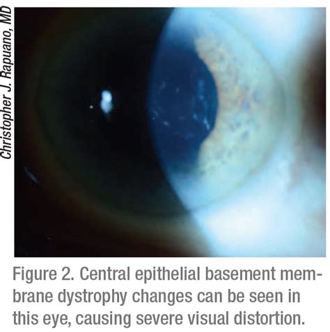 Anterior Basement Membrane Dystrophy Symptoms - Openbasement