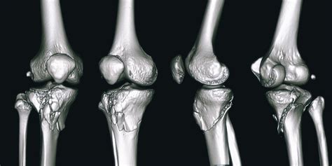 Proximal Tibial Plateau Fracture