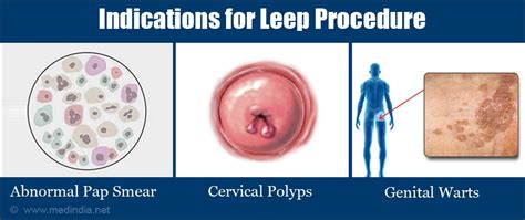 LEEP (Loop Electrosurgical Excision Procedure) - Indications, Preparation, Procedure, Recovery ...