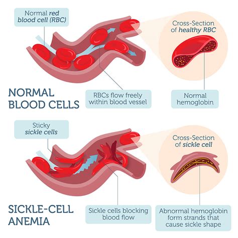 Sickle Cell Anemia DNA Test – DNA Access Lab