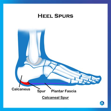 Heel Spurs | Dr. Abbie Clinics