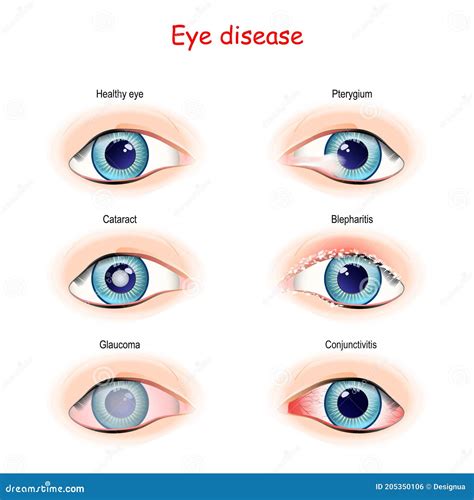 Eye Of Human. Blepharitis. Inflammation Of The Eyelid Cartoon Vector | CartoonDealer.com #106730229