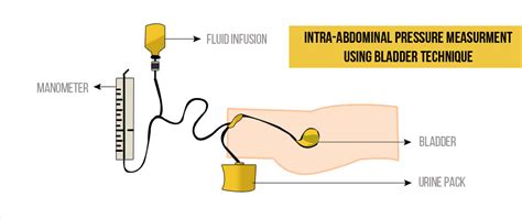 Abdominal Compartment Syndrome Treatment - Captions Hunter