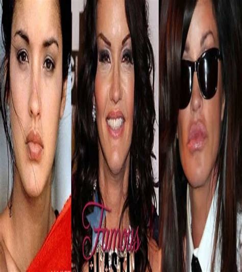 20 Of The Worst Celebrity Plastic Surgery Disasters