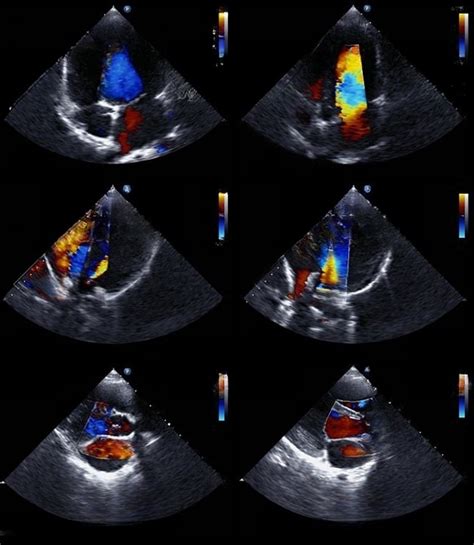 Echocardiography Training at Heartscope Training Institute