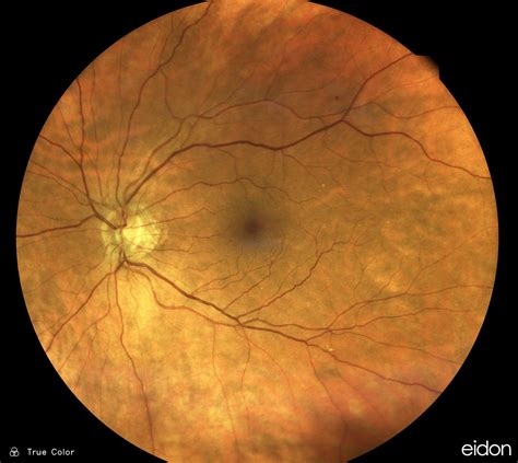 A retinal photo showing a normal macula – KindSIGHT