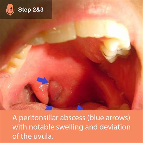 Deviated Uvula Sore Throat