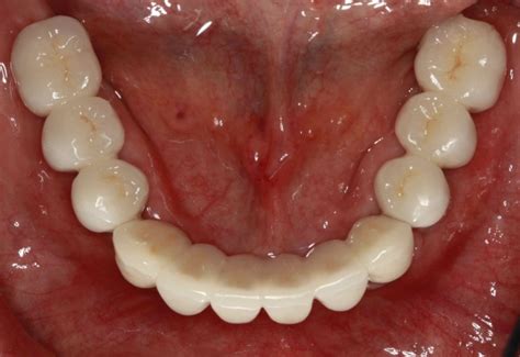 How Many Implants in the Edentulous Mandible? - Spear Education