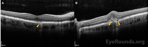 EyeRounds.org: Punctate Inner Choroidopathy with Choroidal Neovascular Membrane